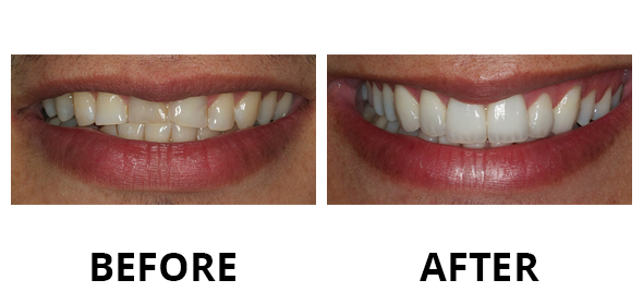 veneers-01