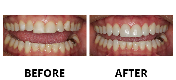 veneers-02