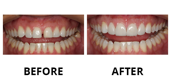 veneers-03