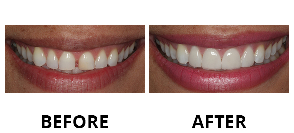veneers-04