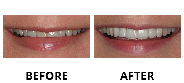 veneers-05