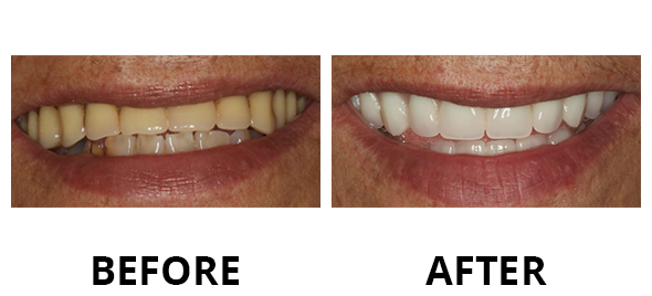 veneers-06
