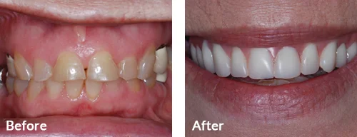 before-after-002