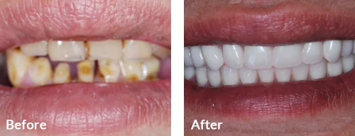 before-after-006