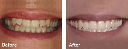 before-after-008