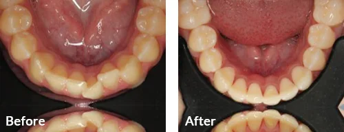 before-after-010
