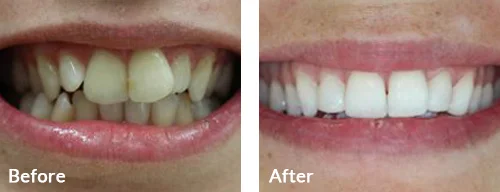 before-after-011
