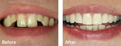 before-after-012