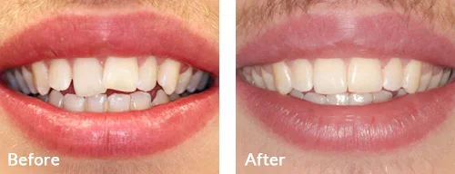 before-after-014