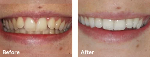 before-after-016