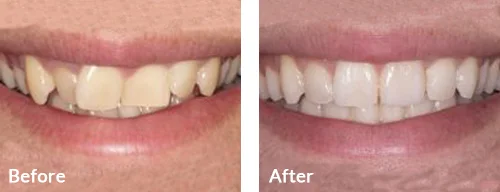 before-after-018
