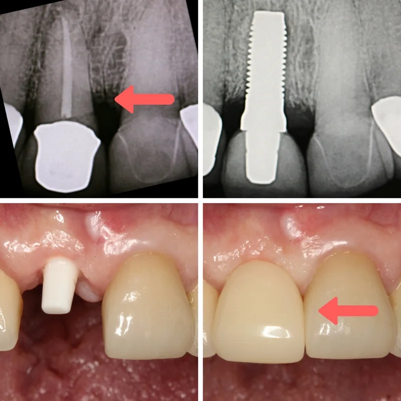 dental-implan8