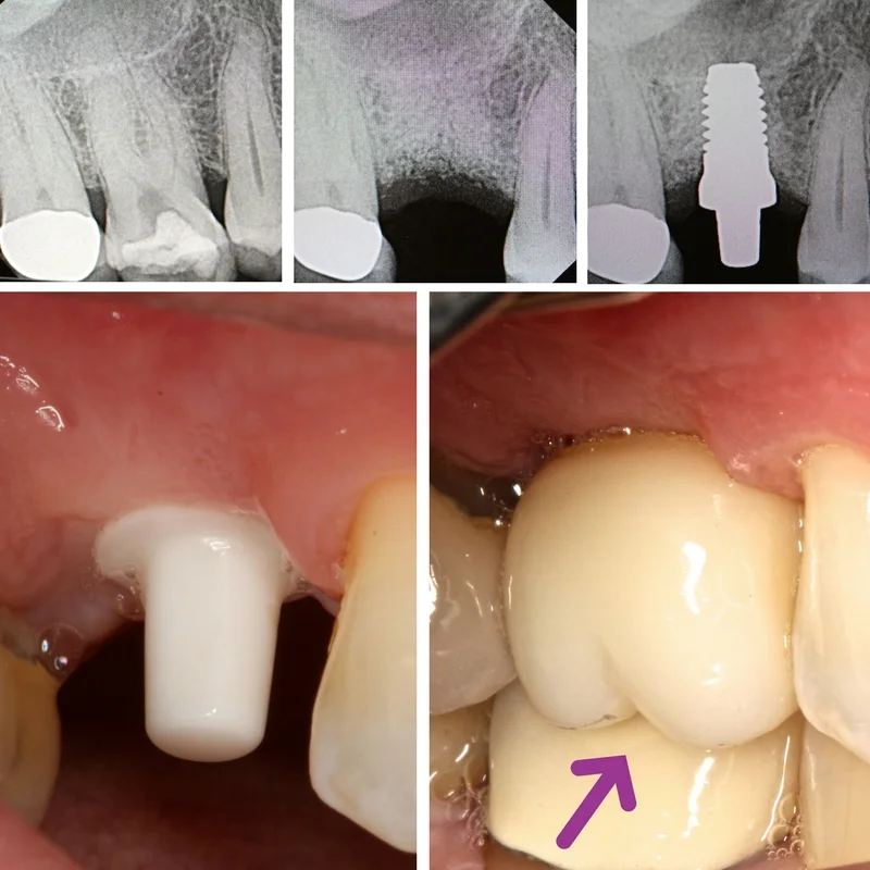 dental-implan9