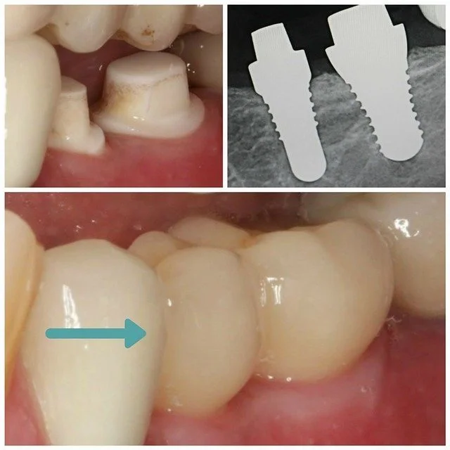 dental-implant1