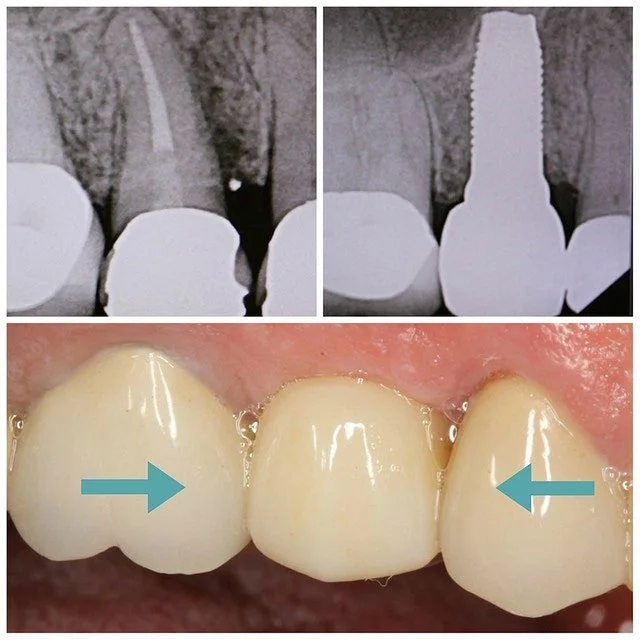 dental-implant2
