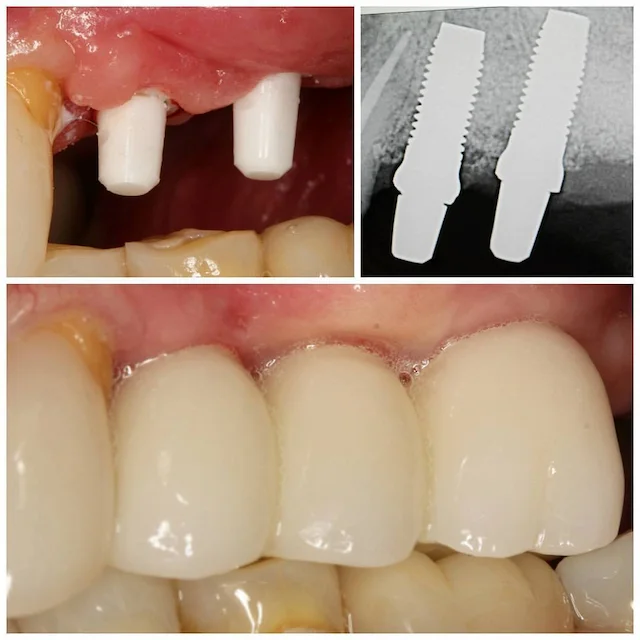 dental-implant3