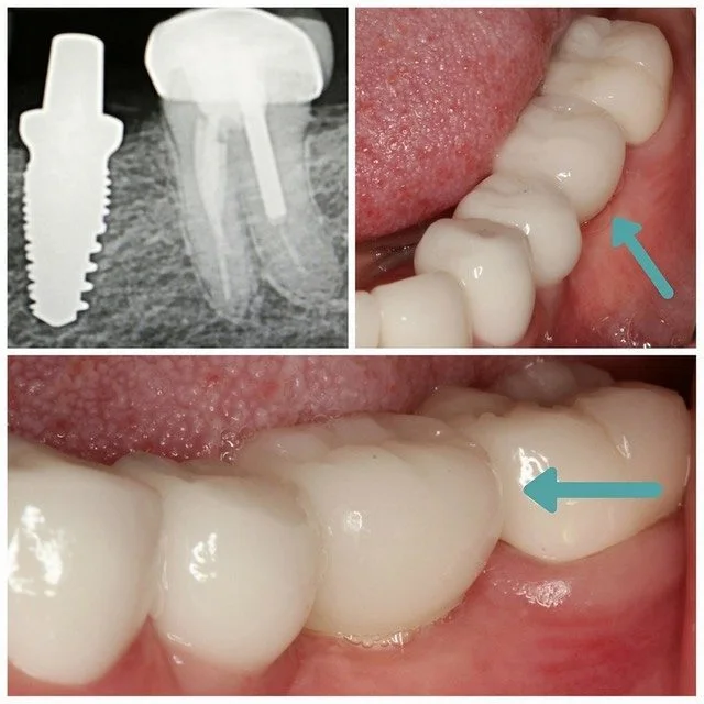 dental-implant4