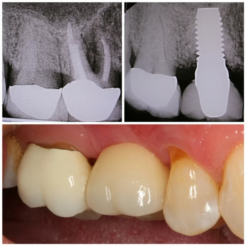 dental-implant5