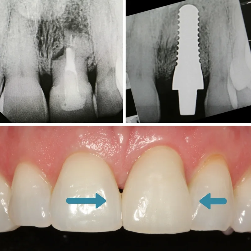dental-implant6
